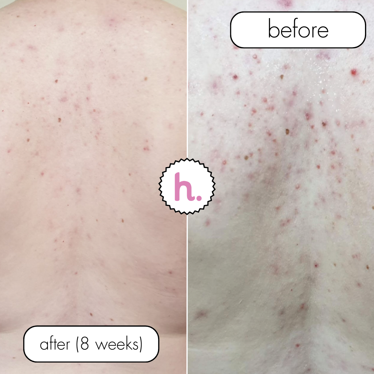 No Filter / Azelaic Acid 20% w/w Body Moisturiser