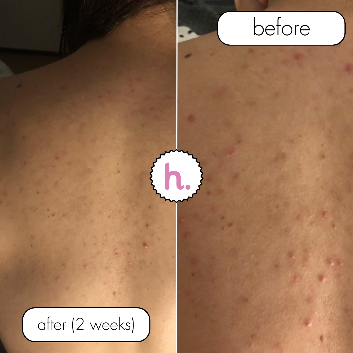 No Filter / Azelaic Acid 20% w/w Body Moisturiser