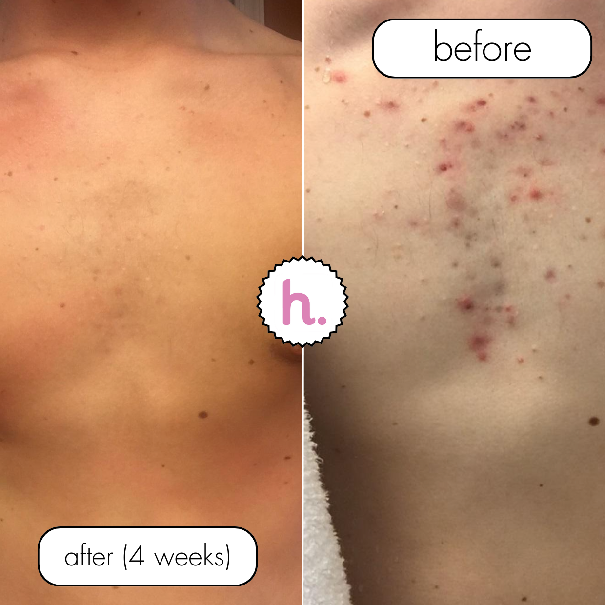 No Filter / Azelaic Acid 20% w/w Body Moisturiser